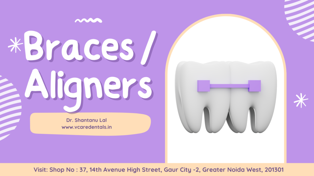 Braces / Aligners